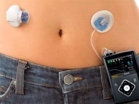 Nuevas tecnologías para el tratamiento de la diabetes