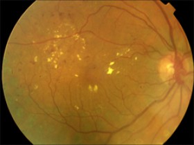 La retina: órgano diana de la diabetes